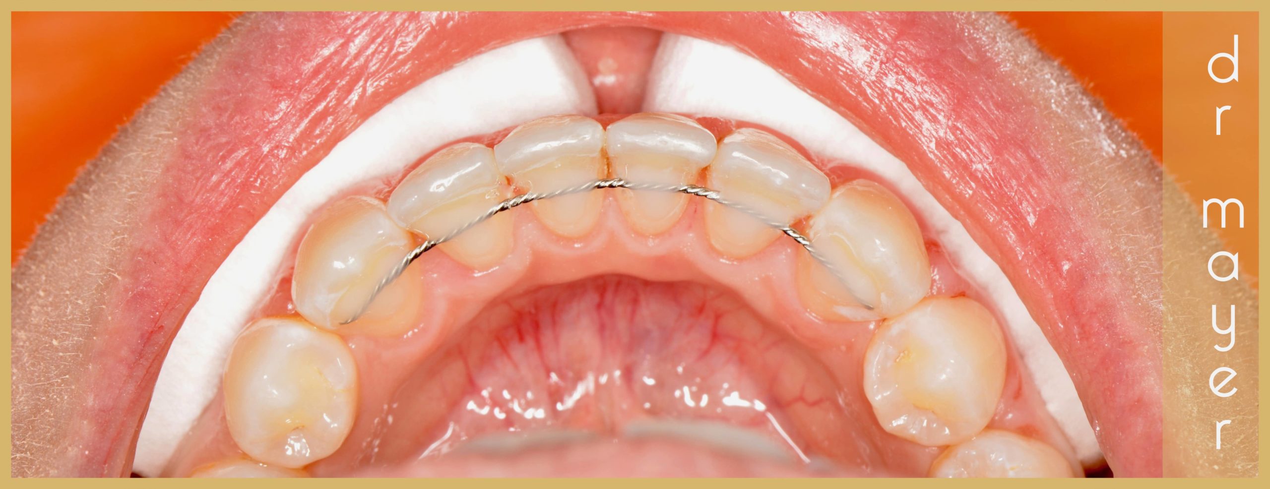 retainer