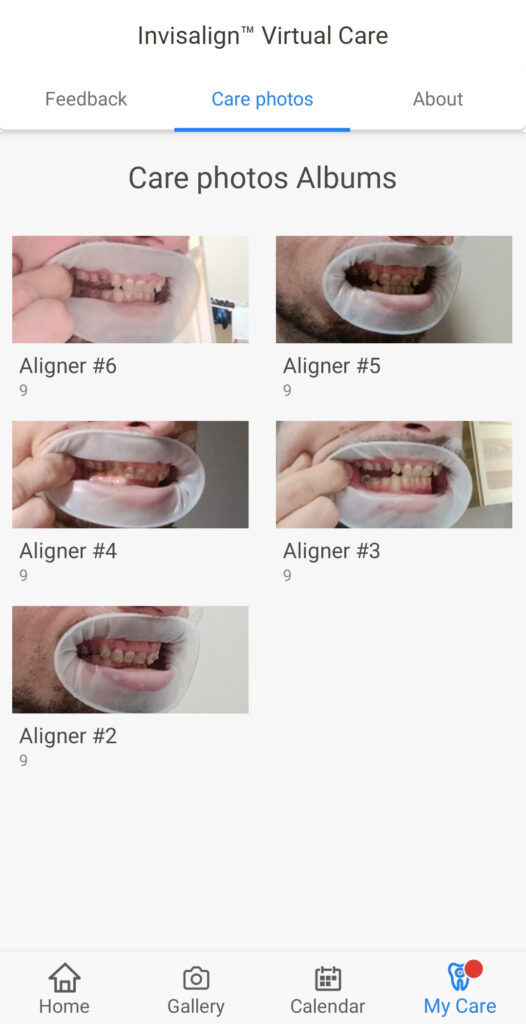 kép készítés invisalign app